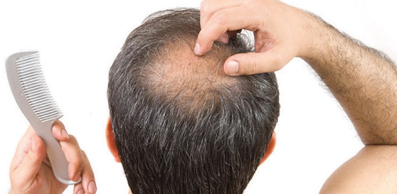 Medical Treatments for Hair Loss